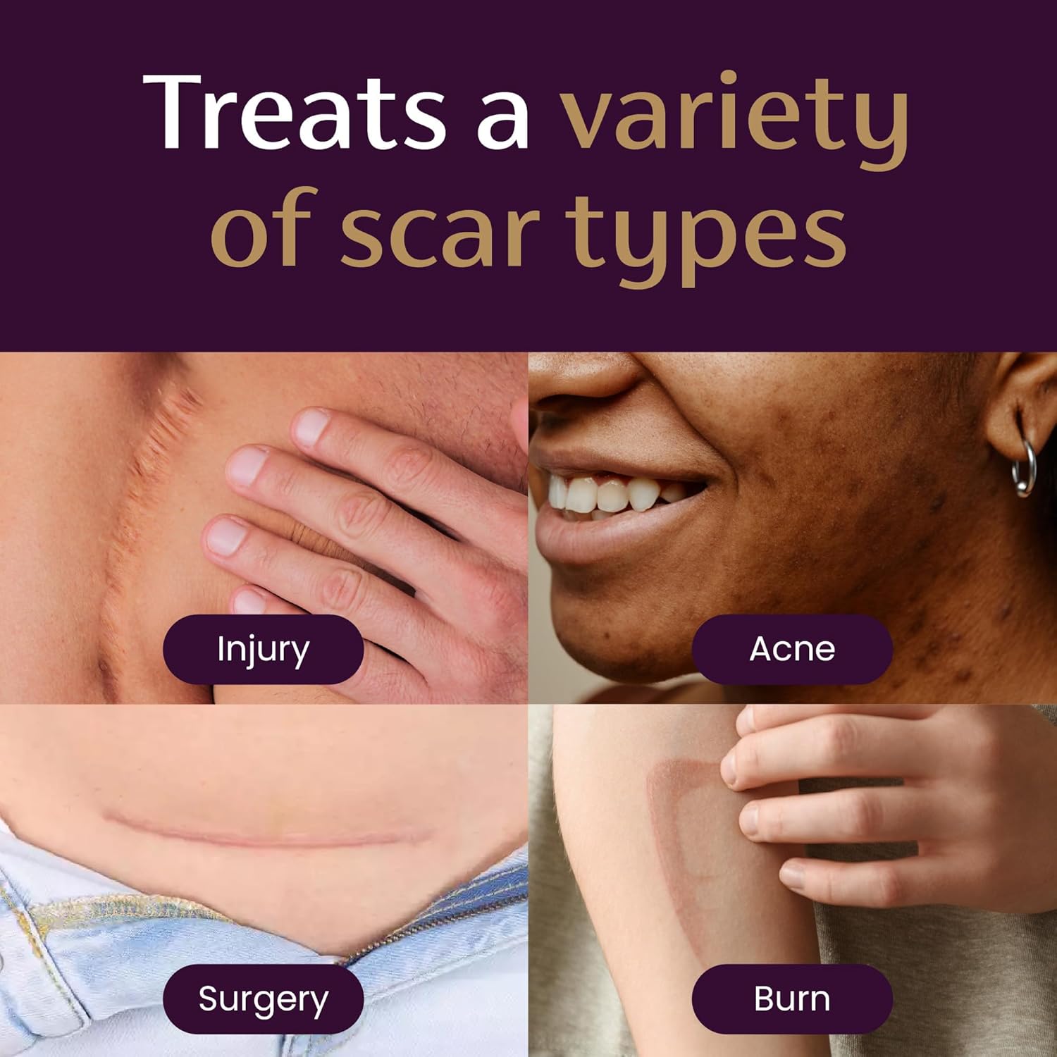 1.7 Oz Scar Cream R55520